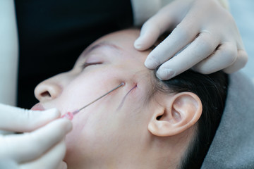 Close-up of fine Thread Lifting, PDO thread. Aesthetic beauty anti aging, face lifting surgery.