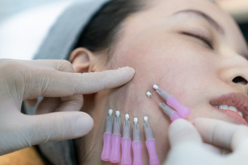 Close-up of fine Thread Lifting, PDO thread. Aesthetic beauty anti aging, face lifting surgery.
