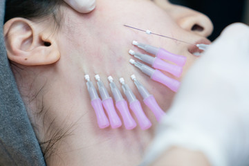 Close-up of fine Thread Lifting, PDO thread. Aesthetic beauty anti aging, face lifting surgery.