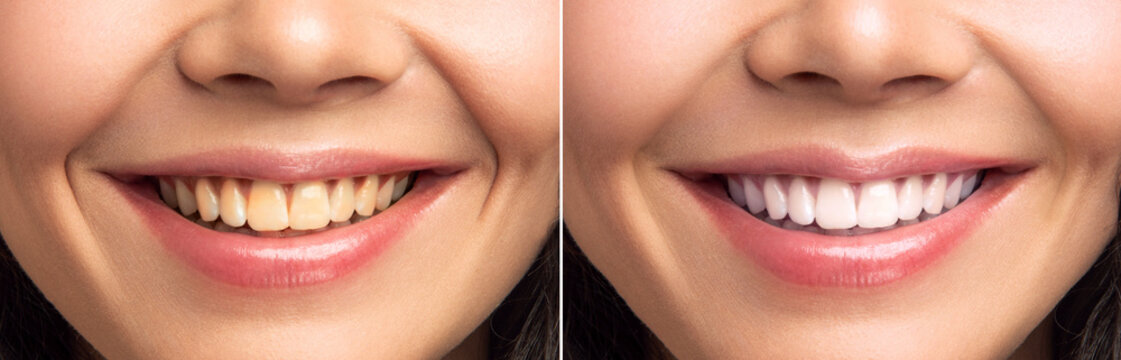 Close-up Of Smiling Woman Teeth Before And After Whitening 