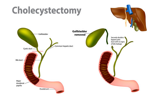 Gallbladder Removal Surgery (Laparoscopic cholecystectomy)