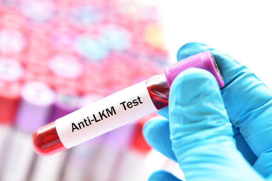 Blood sample for Anti-Liver Kidney Microsomal or Anti-LKM test