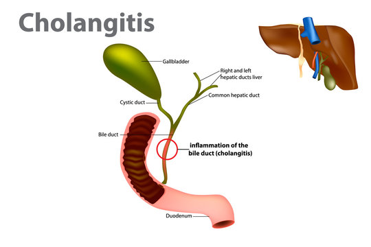 Inflammation of the bile duct (Ascending cholangitis or acute cholangitis)