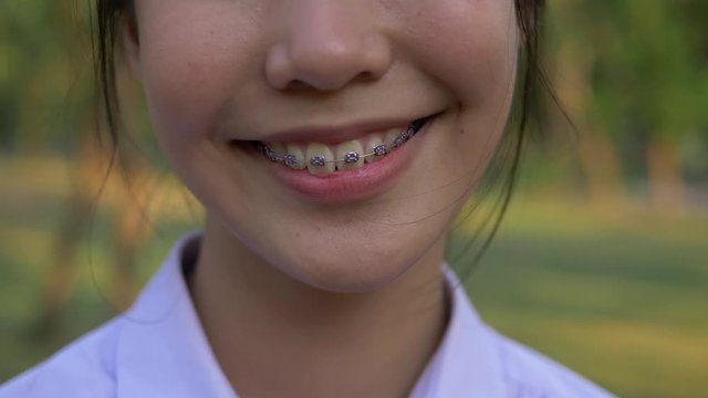 Close up asian young girl mouth with braces on teeth. young girl looking at the camera laughing and smiling.
