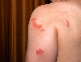 Red Spot Inflammation skin cause by Insect bite. Skin rash and allergy from mosquito bite.