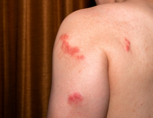 Fototapeta premium Red Spot Inflammation skin cause by Insect bite. Skin rash and allergy from mosquito bite.