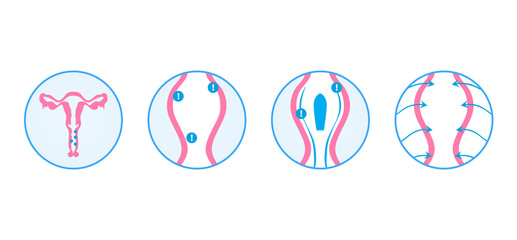 Gynecological infographics. Treatment of vaginitis suppositories. Inflammation of the vagina. Vector illustration. 