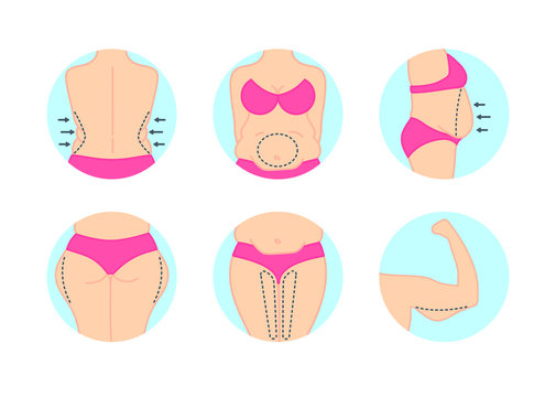 Fat thighs stock vector. Illustration of liposuction - 40168911