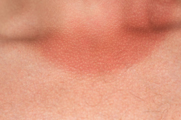 Closeup view of male body with sunburned red skin in area of neck. Horizontal color photography.