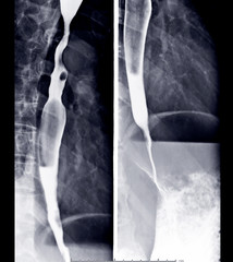 Esophagram or Barium swallow AP view Compare afterThe patient drinks a liquid that contains barium showing esophagus.