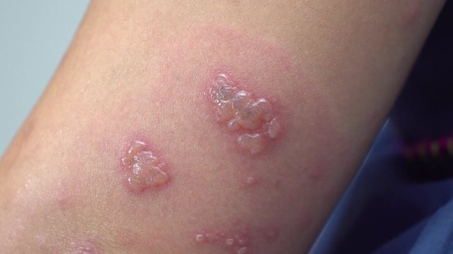 Shingles, Zoster or Herpes Zoster symptoms on arm