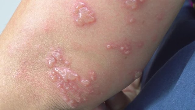 Shingles, Zoster or Herpes Zoster symptoms on arm