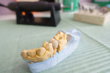 dentist examines artificial dental crowns on a model