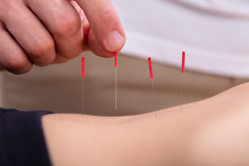 Close-up Of Woman Undergoing Acupuncture Treatment On Her Belly
