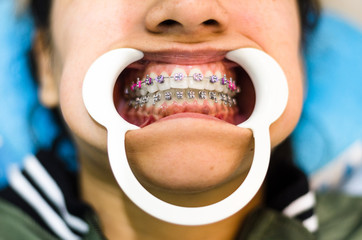 Closeup of young woman's teeth with braces and retractor for mouth.