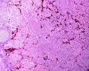 Skin. Nevoepithelioma