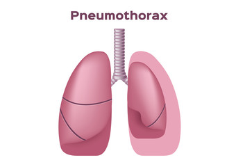 symptoms of pneumothorax lung vector