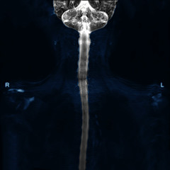 MRI of cervical spine use technique myelogram on Coronal plane for diagnostic Spinal Cord...