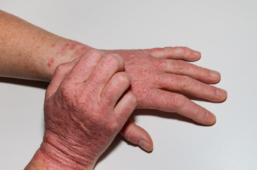 A psoriasis patient scratches his hands. Itching of the skin with chronic dermatoses - psoriasis, eczema, dermatitis.