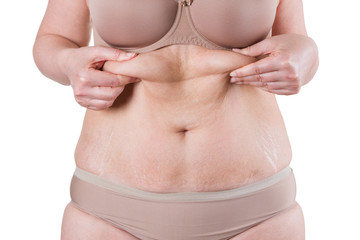 Tummy tuck, flabby skin on a fat belly, plastic surgery concept