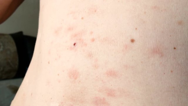 skin rash treatment on woman body. Shingles, Disease, Herpes zoster, varicella-z, lichenoid dermatitis