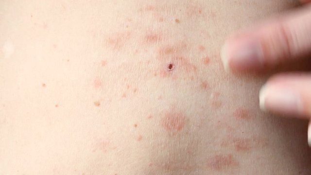 skin rash treatment on woman body. Shingles, Disease, Herpes zoster, varicella-z, lichenoid dermatitis