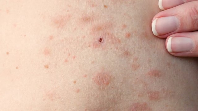 skin rash treatment on woman body. Shingles, Disease, Herpes zoster, varicella-z, lichenoid dermatitis