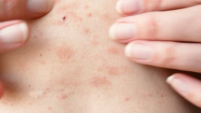 skin rash treatment on woman body. Shingles, Disease, Herpes zoster, varicella-z, lichenoid dermatitis