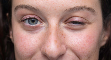 close up on blue eyes girl face with one half closed eye, Myasthenia gravis (MG) disease