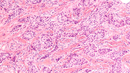 Breast cancer histology (core biopsy): Microscopic image (photomicrograph) of an infiltrating...