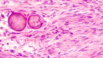 Stereotactic brain biopsy smear cytology of a meningioma, a benign brain tumor of the meninges, showing fascicles of spindle cells with psammoma bodies.
