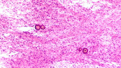 Stereotactic brain biopsy smear cytology of a meningioma, a benign brain tumor of the meninges,...