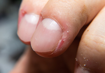 Dermatophagia Skin Disease Fingers 