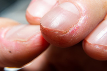 Dermatophagia Skin Disease Fingers 
