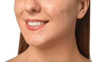 Obraz premium Young woman with acne problem on white background, closeup