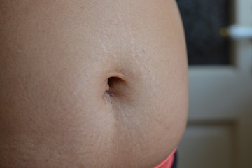Scar on the belly button of a person after an operation