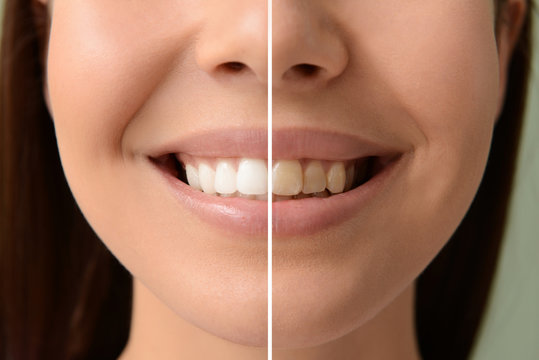Woman before and after whitening of her teeth, closeup