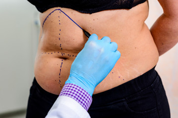 The doctor drawing lines on the patient’s skin