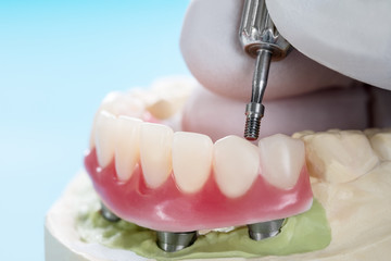Closeup/ Dental implants supported overdenture on blue background.