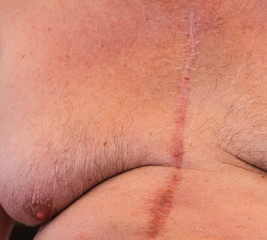 A scar from a heart operation