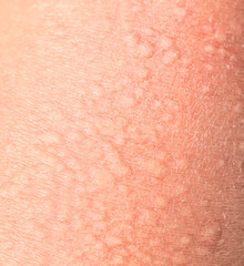 background of the texture unhealthy irritated human skin covered with small wrinkles ,cracks and blistering