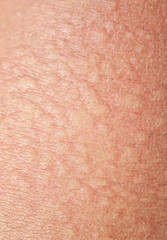 background of the texture unhealthy irritated human skin covered with small wrinkles ,cracks and blistering
