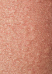 background of texture of unhealthy irritated human skin covered with fine lines ,cracks and blisters burns