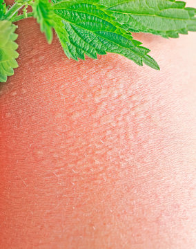 plant stinging nettle lying on irritated human skin covered with small wrinkles ,cracks and causes a burn with blisters