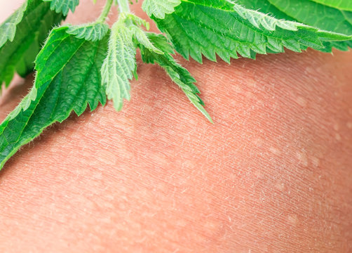plant stinging nettle lying on irritated human skin covered with small wrinkles ,cracks and causes a burn with blisters