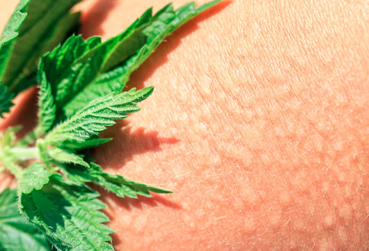 plant stinging nettle lying on irritated human skin covered with small wrinkles ,cracks and causes a burn with blisters