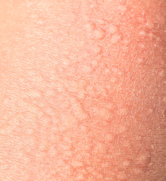 background of the texture unhealthy irritated human skin covered with small wrinkles ,cracks and blistering