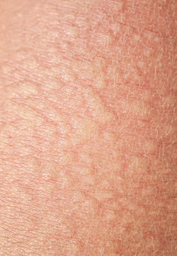 background of the texture unhealthy irritated human skin covered with small wrinkles ,cracks and blistering
