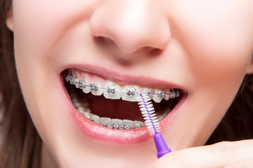 Dental Hygiene Concepts. Extreme Closeup of Female Teenager Mouth Using Bristle Brush for Cleaning Braces and Teeth.