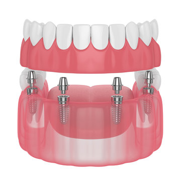 3d render of implant partial denture